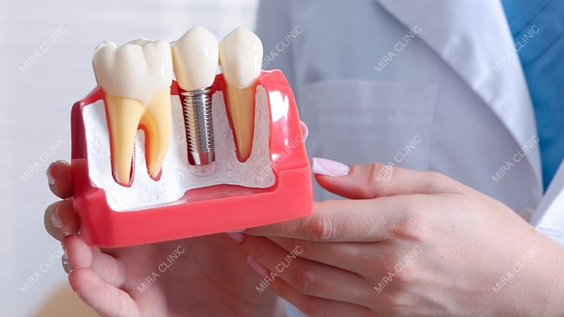Dental Implant Included in the Plan
